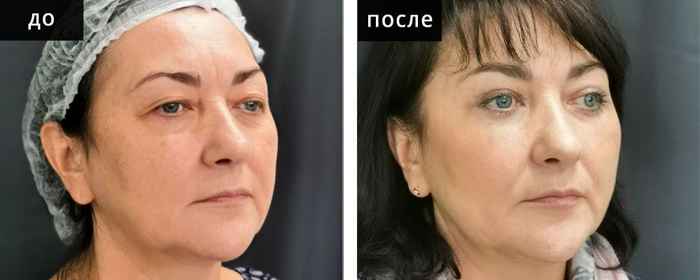 Блефаропластика: до и после – фото 56