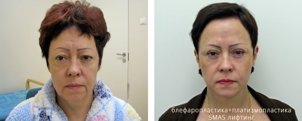 Лифтинг лица: до и после – фото 8