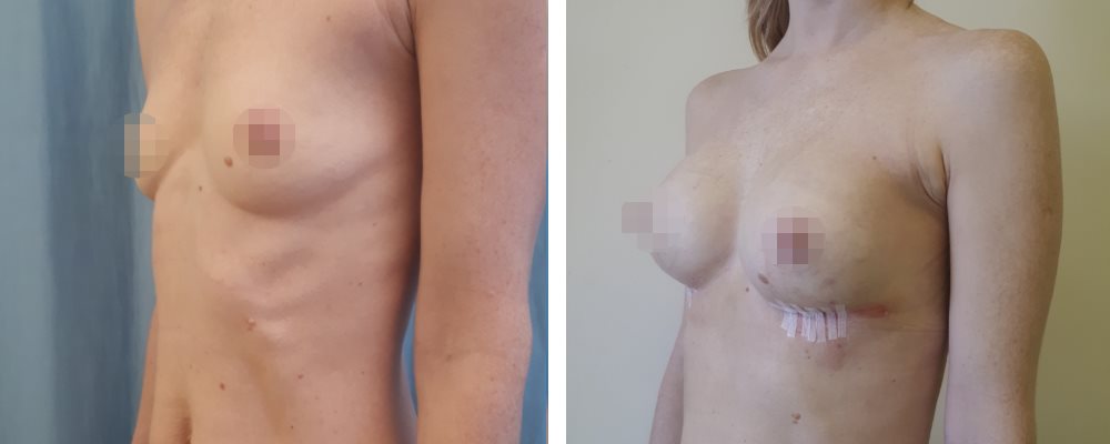 Горячих Мамопластика: до и после – фото 3