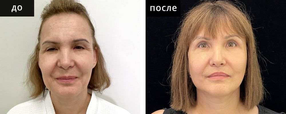 Лифтинг лица: до и после – фото 4