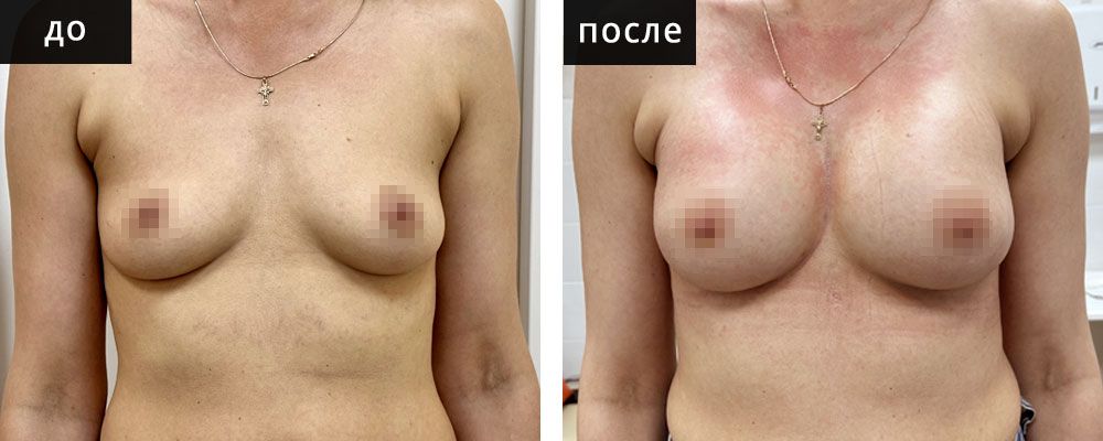 Маммопластика - увеличение груди. Ганьшин 01: до и после – фото 6