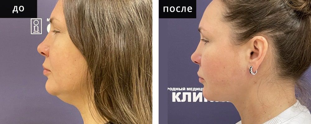 Пластика шеи: до и после – фото 2