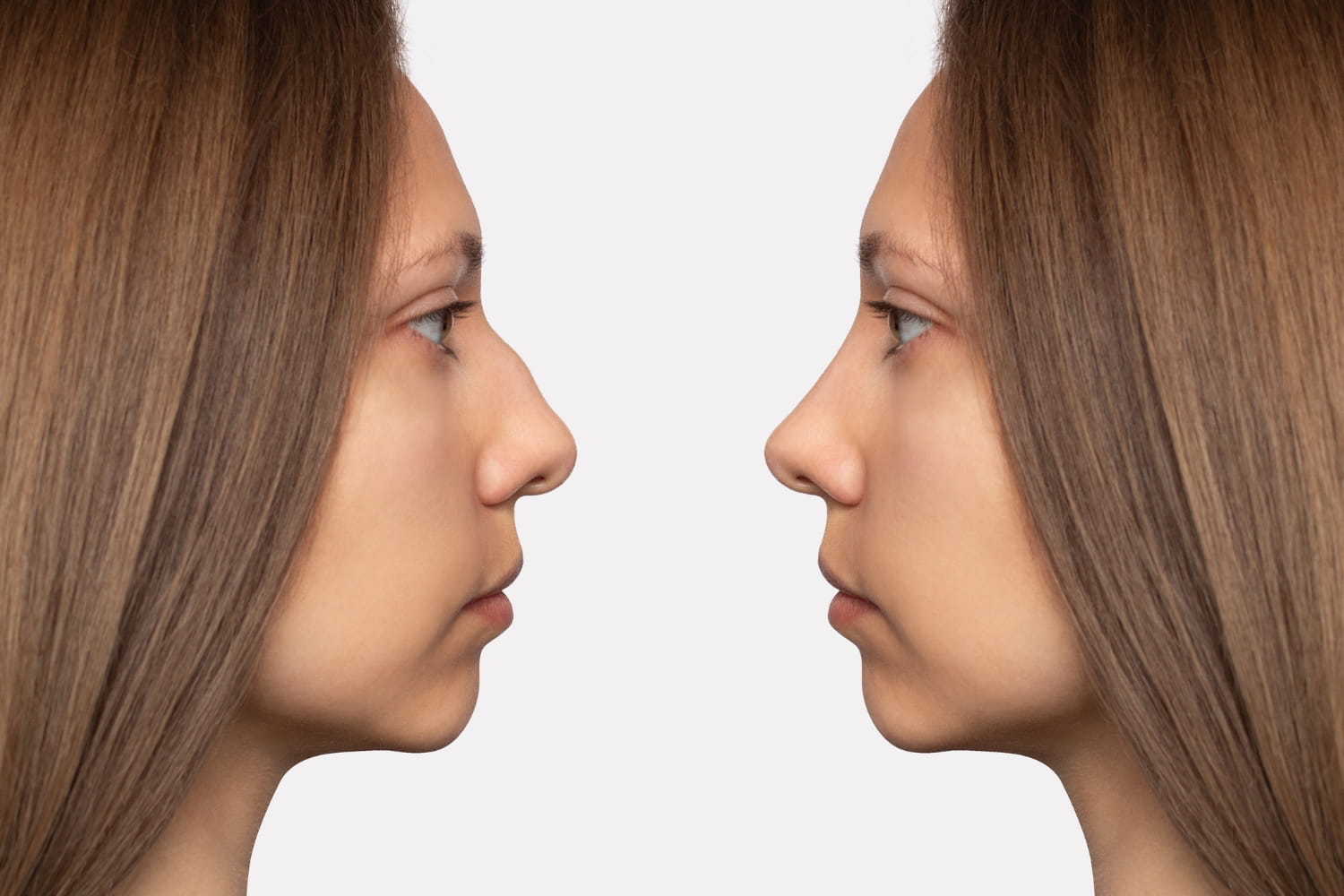 Ринопластика носа в Центре пластической хирургии ОН КЛИНИК Ринопластика носа в Центре пластической хирургии ОН КЛИНИК