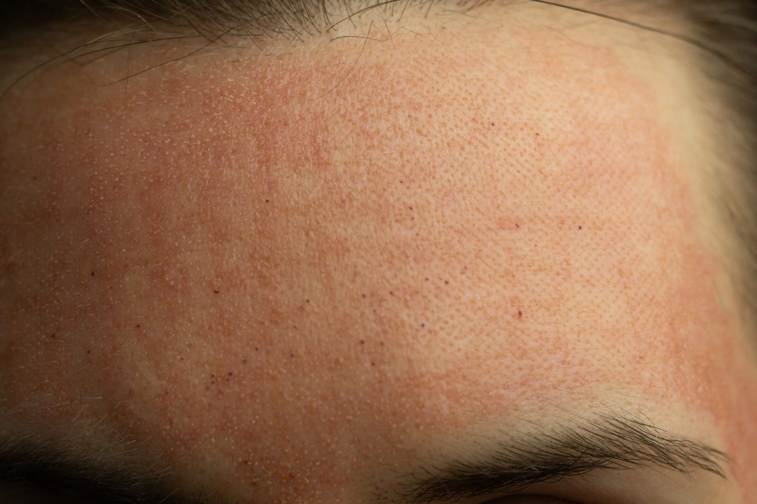 Результат омоложения и шлифовки фракционным лазером CO2 FONS SVR