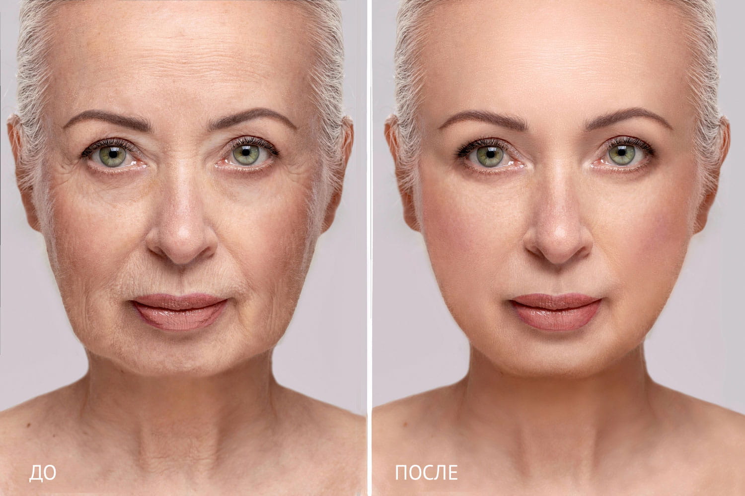 Композитный СМАС-лифтинг. Пример результата до и после