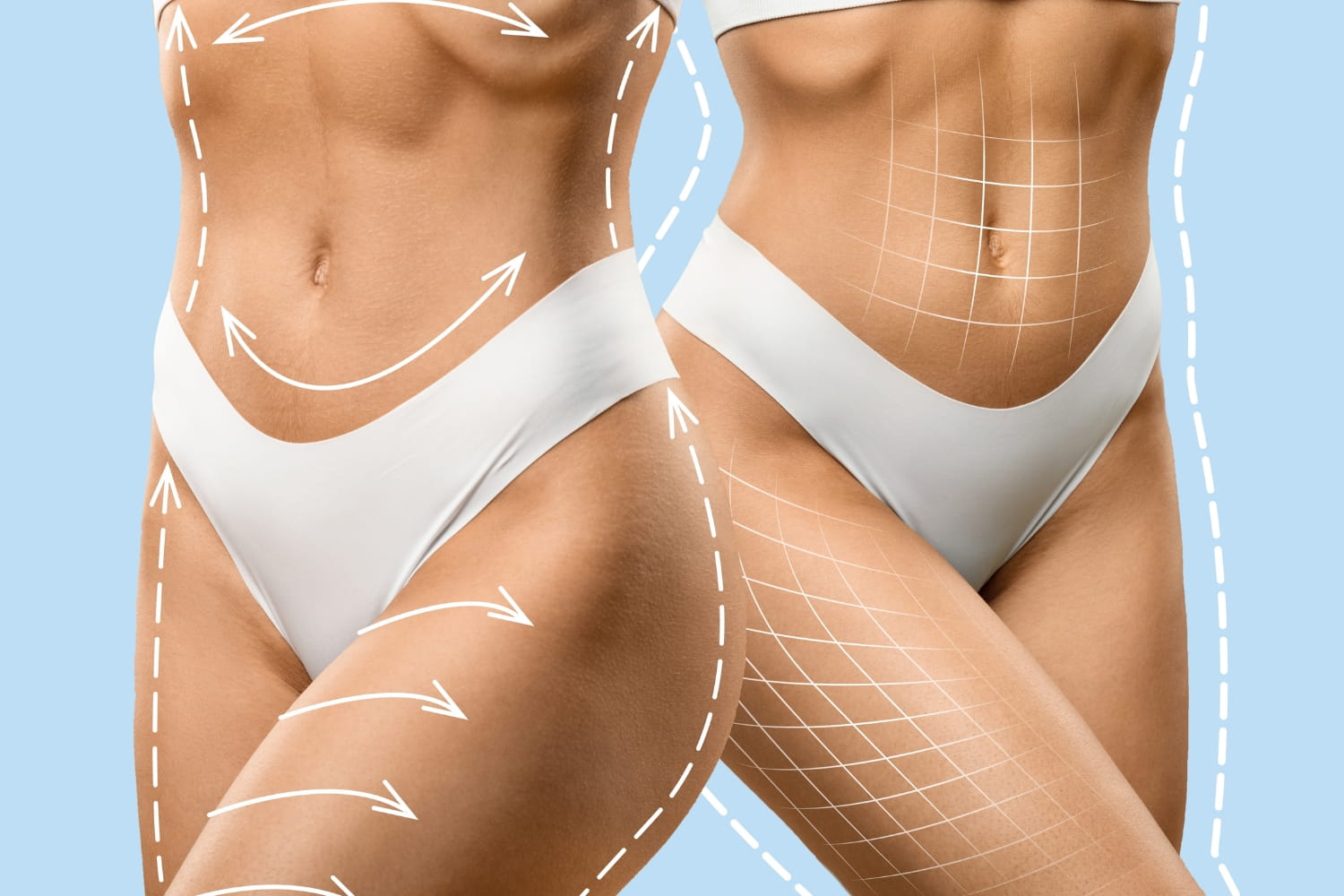 Липосакция 360° (комплексная операция: живот, бока, спина)