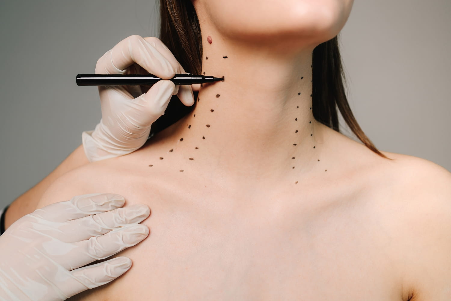 Платизмопластика Платизмопластика