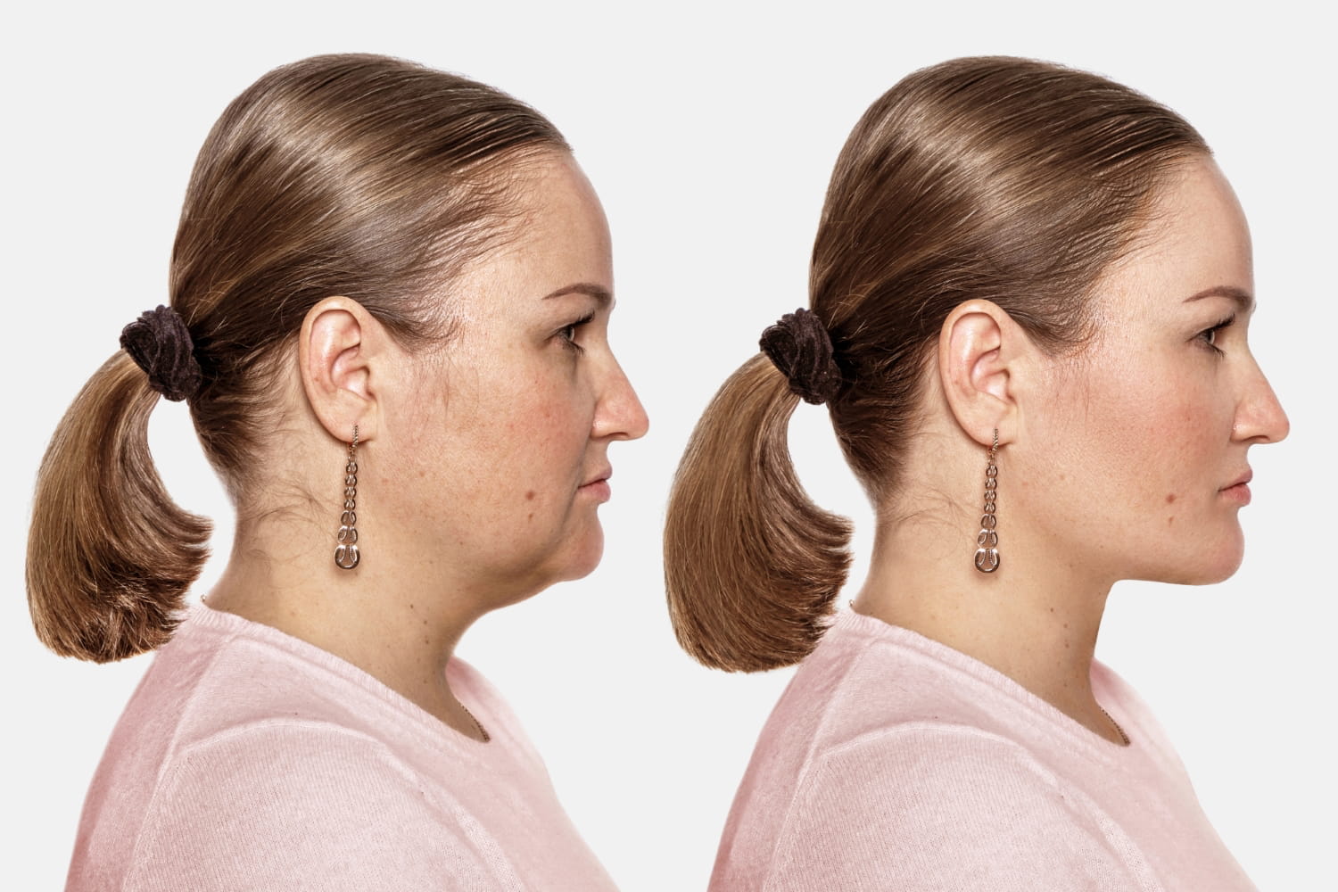 Этапы восстановления после липосакции подбородка по срокам Этапы восстановления после липосакции подбородка по срокам