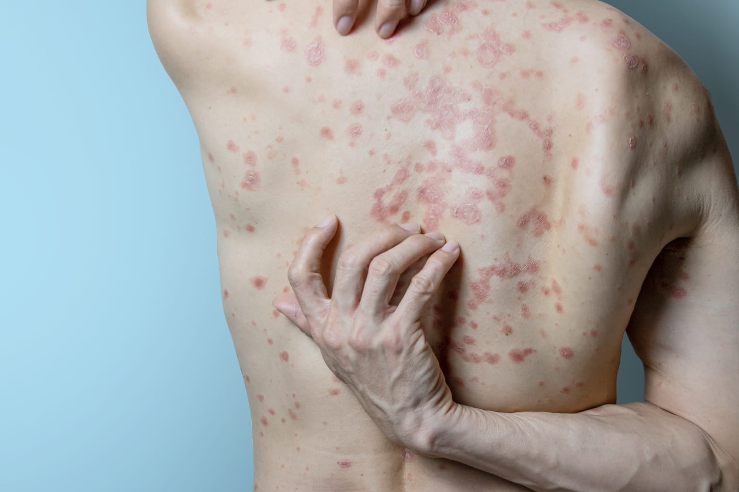 Высыпания на коже