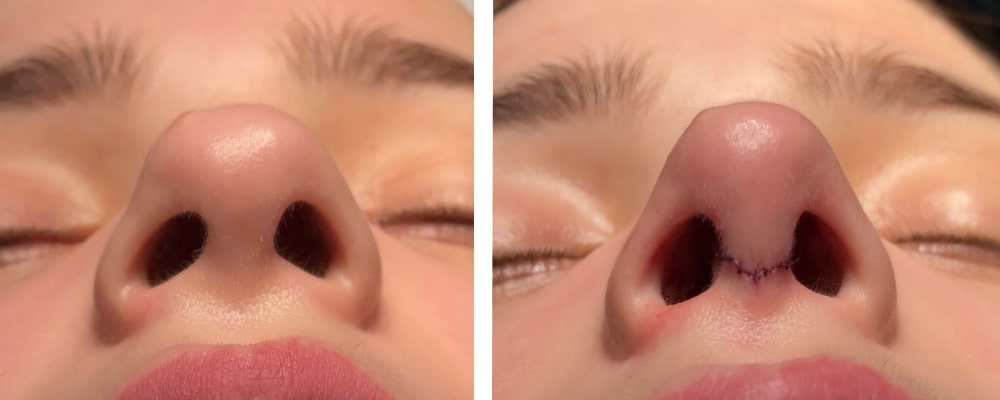 Фото до и после операции риносептопластики Фото до и после операции риносептопластики