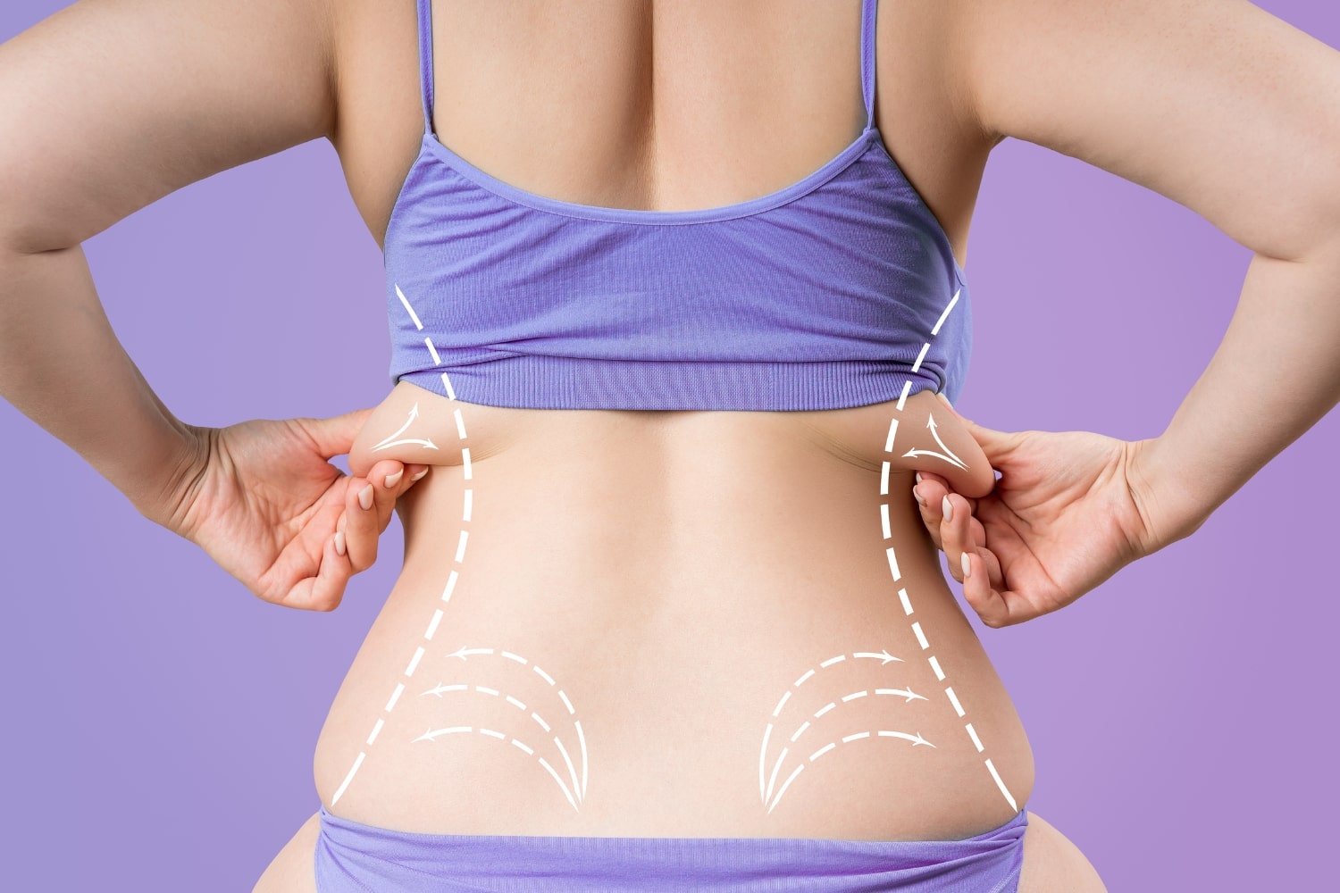 Липосакция талии