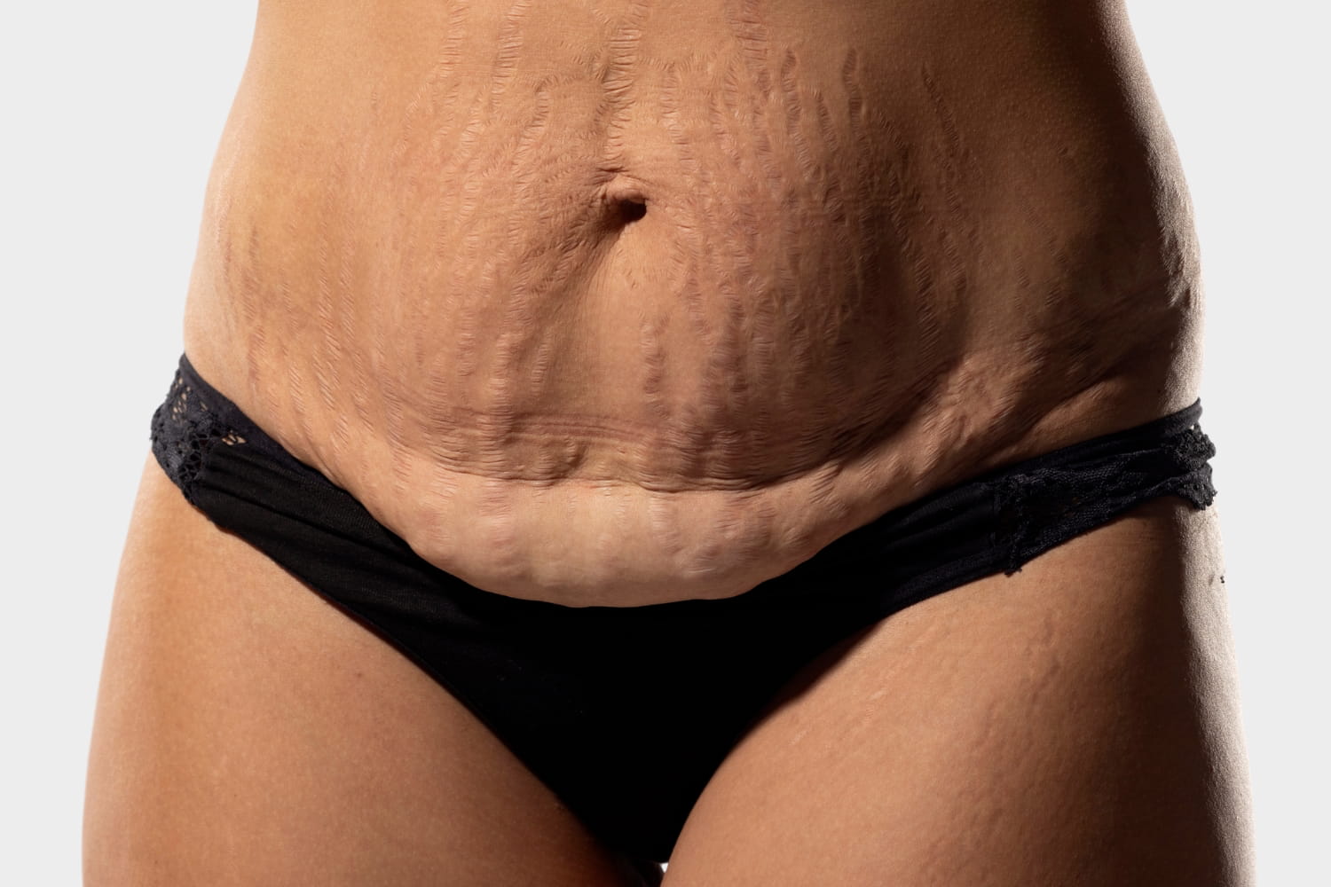 Лишняя кожа после похудения и родов