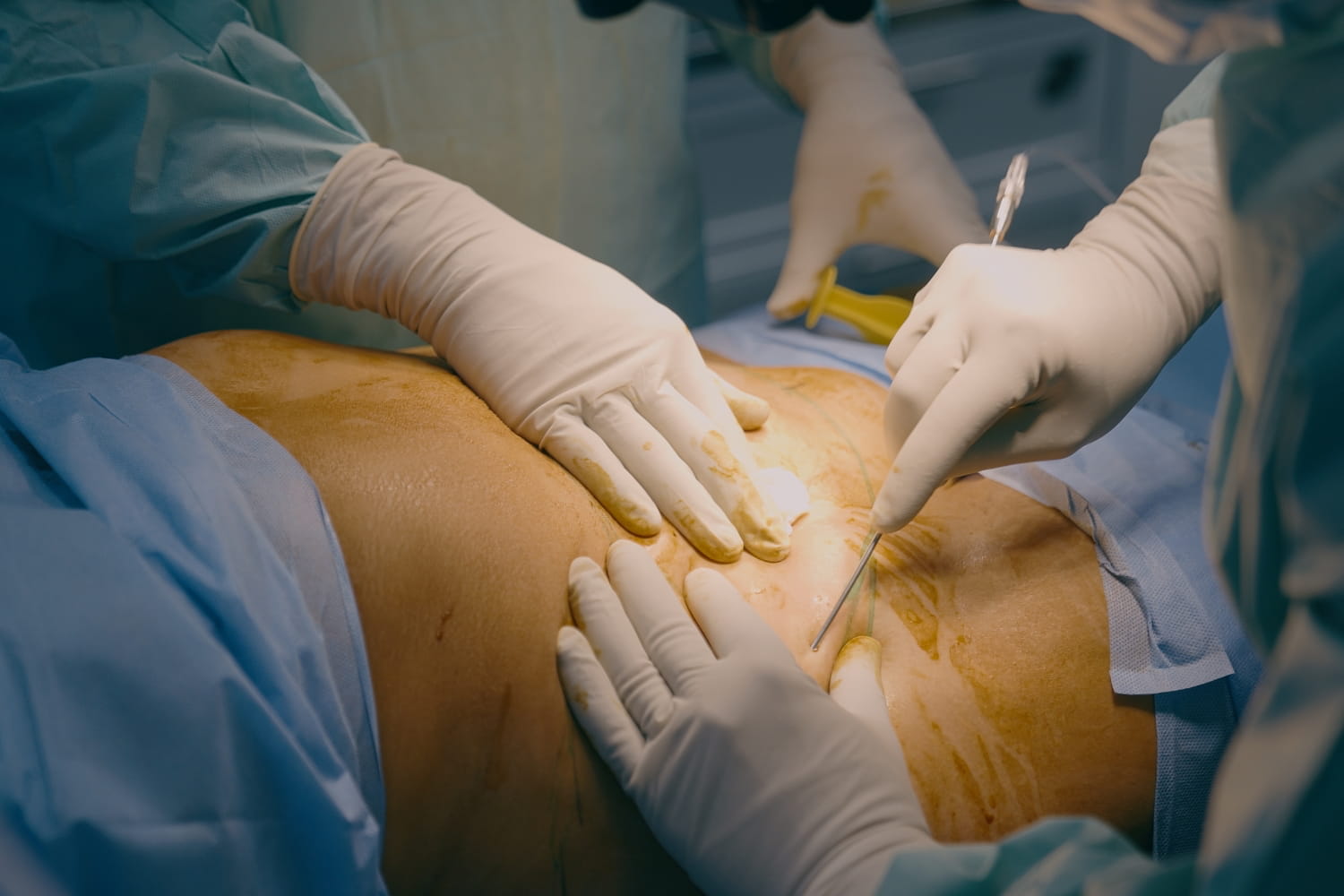 Липосакция 360° (комплексная операция: живот, бока, спина)