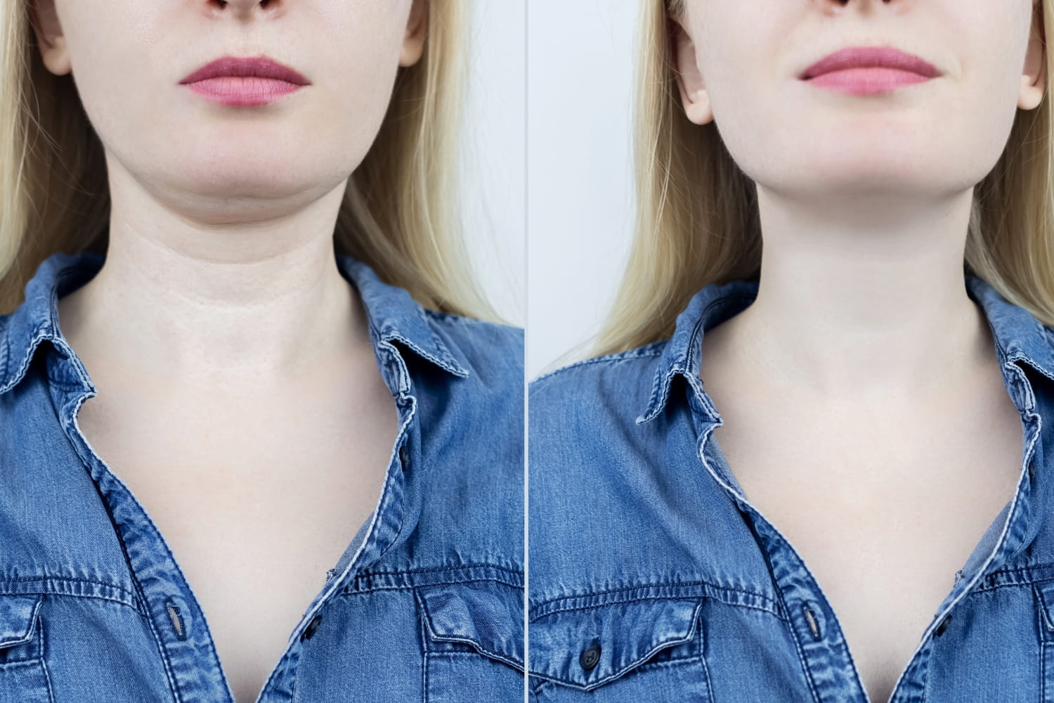 Программа реабилитации после платизмопластики Программа реабилитации после платизмопластики