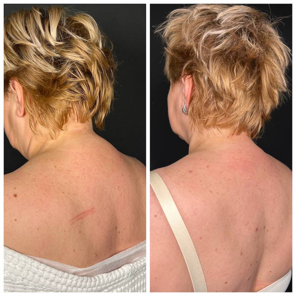 Липосакция холки: результат операции. Пластический хирург ОН КЛИНИК Тарасов Максим Дмитриевич