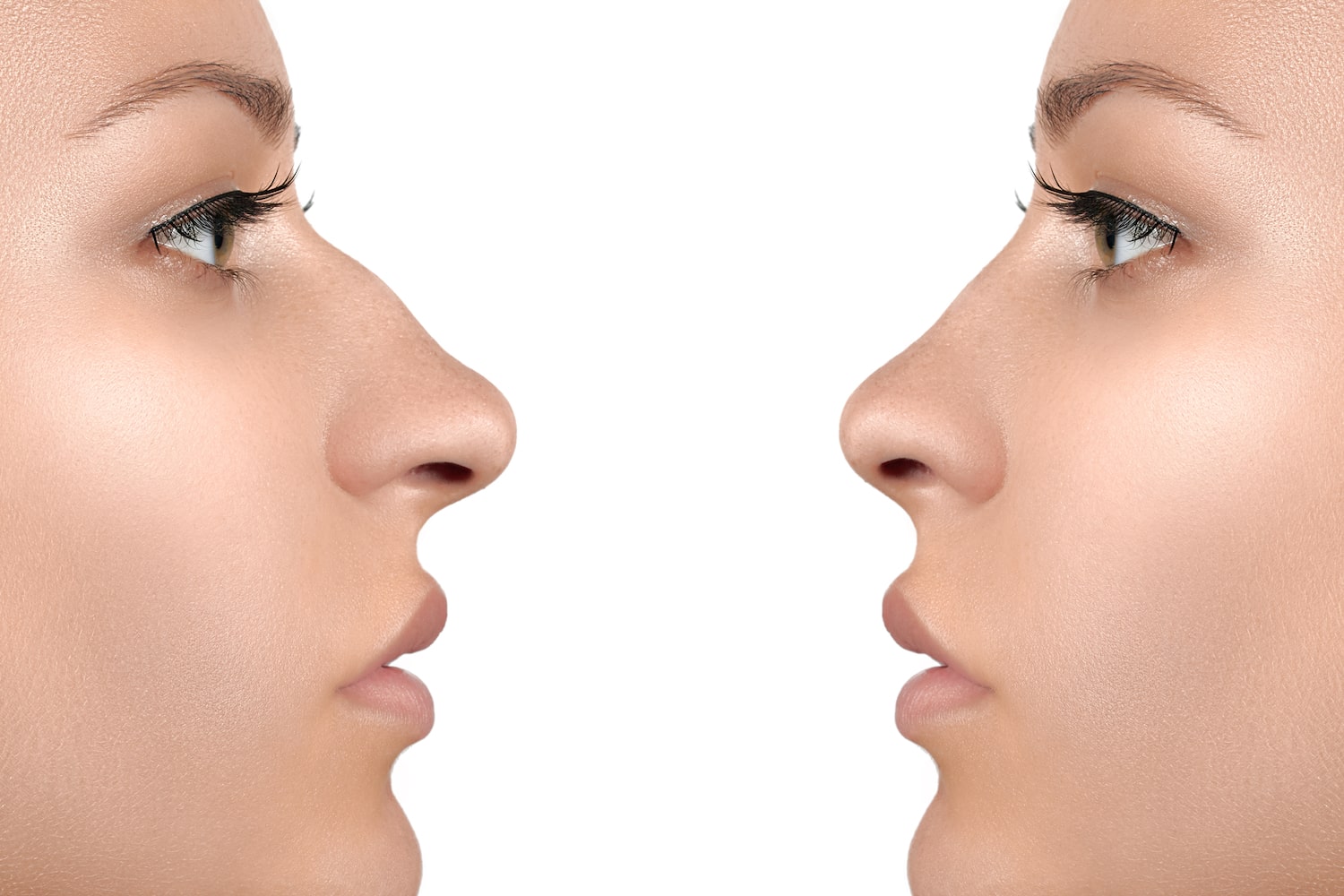Ринопластика седловидного носа