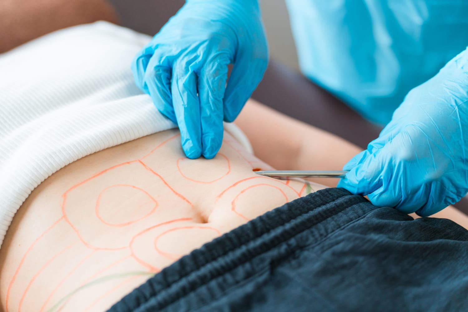 Вибрационная липосакция на аппарате PAL LipoSculptor