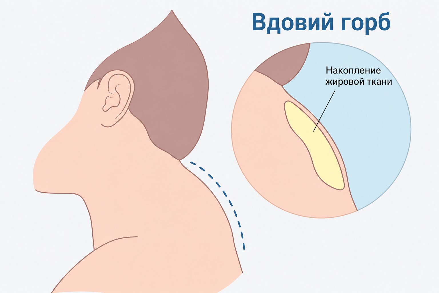 Липосакция вдовьего горба: путь к изящной шее без комплексов