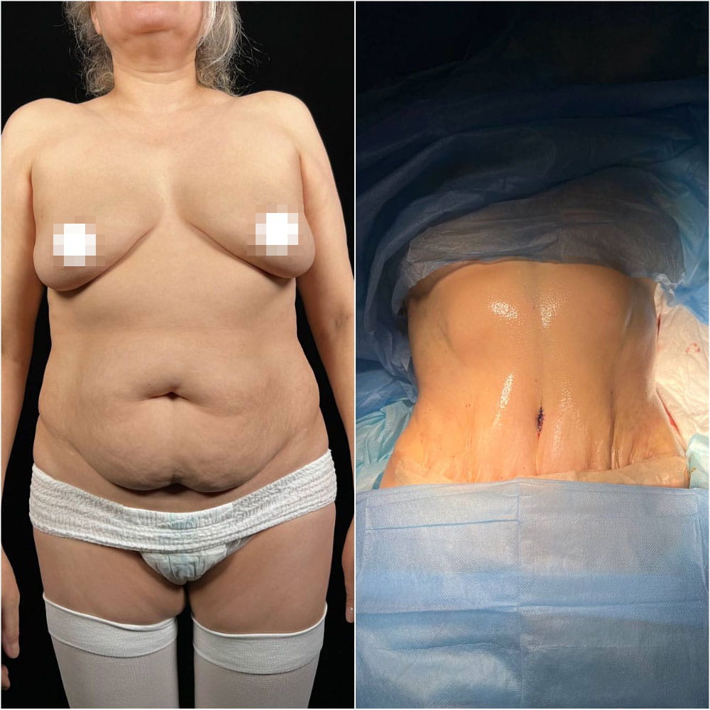 Операция по формированию узкой талии без удаления ребер, липосакция, моделирование спортивной фигуры, абдоминопластика с ушиванием диастаза