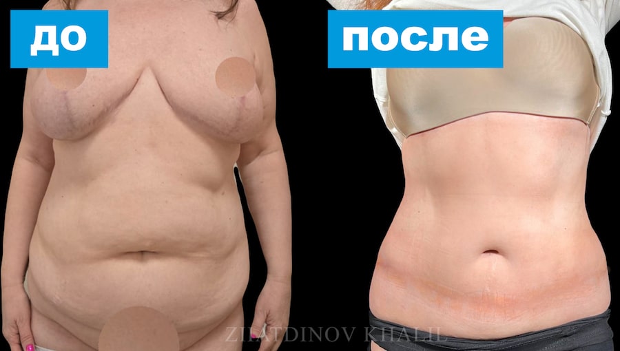 Абдоминопластика с ушиванием диастаза плюс липосакция 360 градусов Абдоминопластика с ушиванием диастаза плюс липосакция 360 градусов