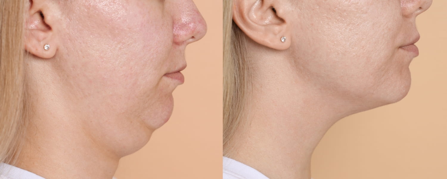 Восстановление после липосакции подбородка Восстановление после липосакции подбородка