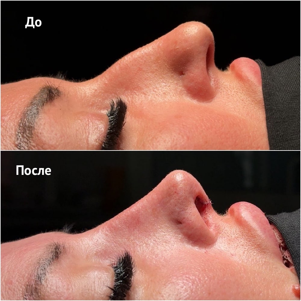 Фото до и после операции риносептопластики