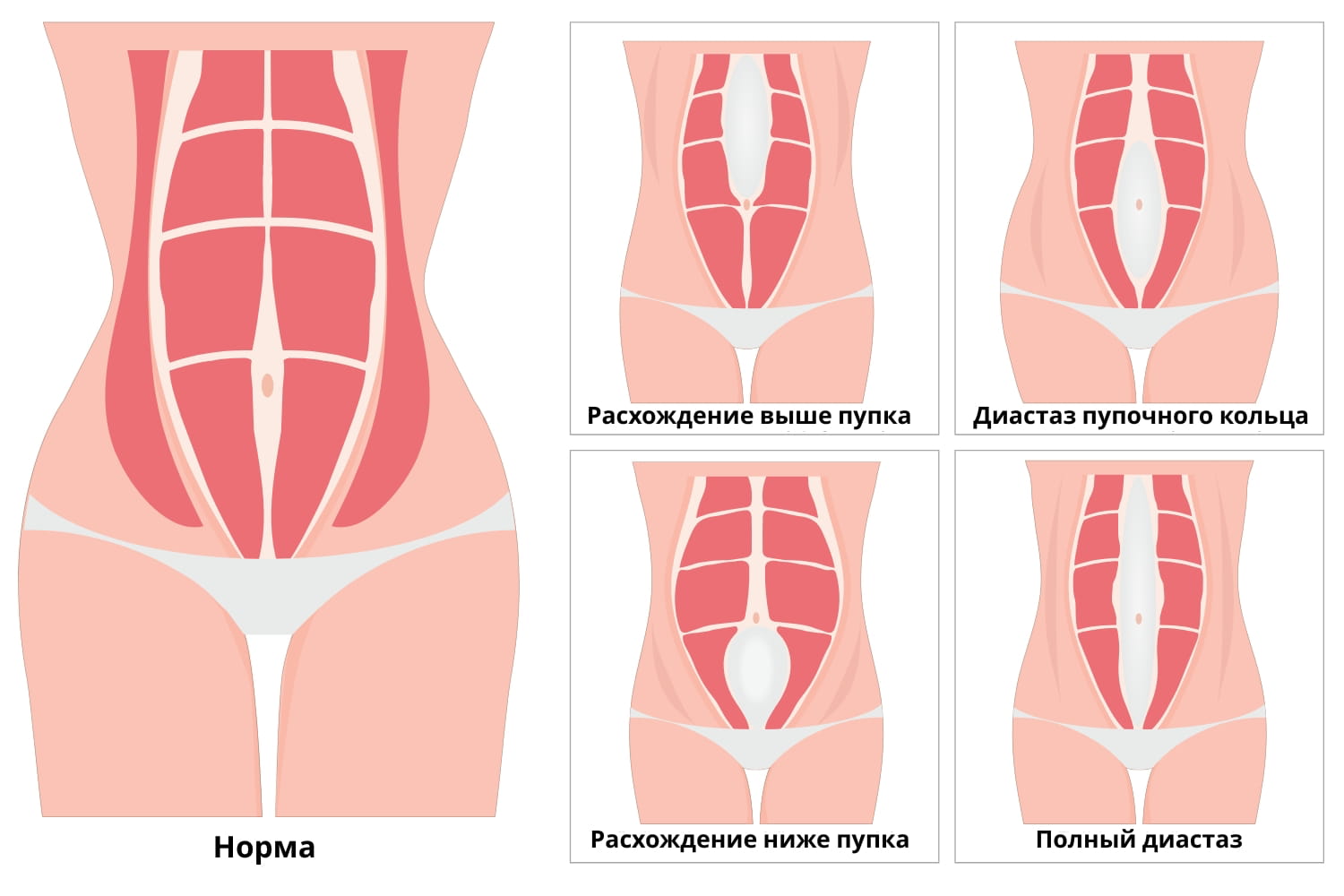Разновидности диастаза