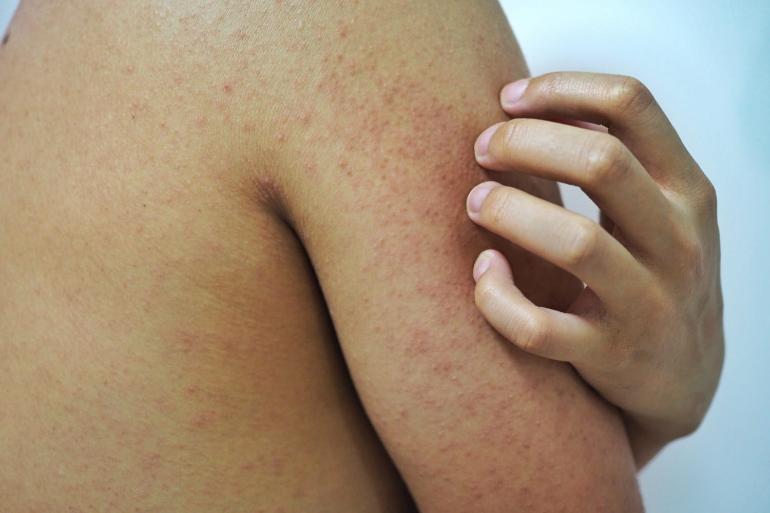 Домашний уход при кератозе