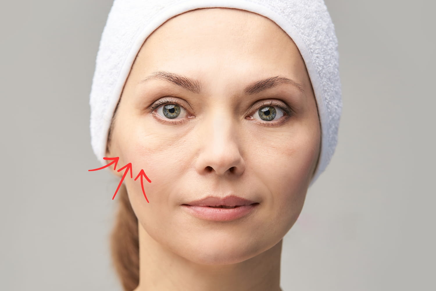 Жировые (малярные) мешки под глазами