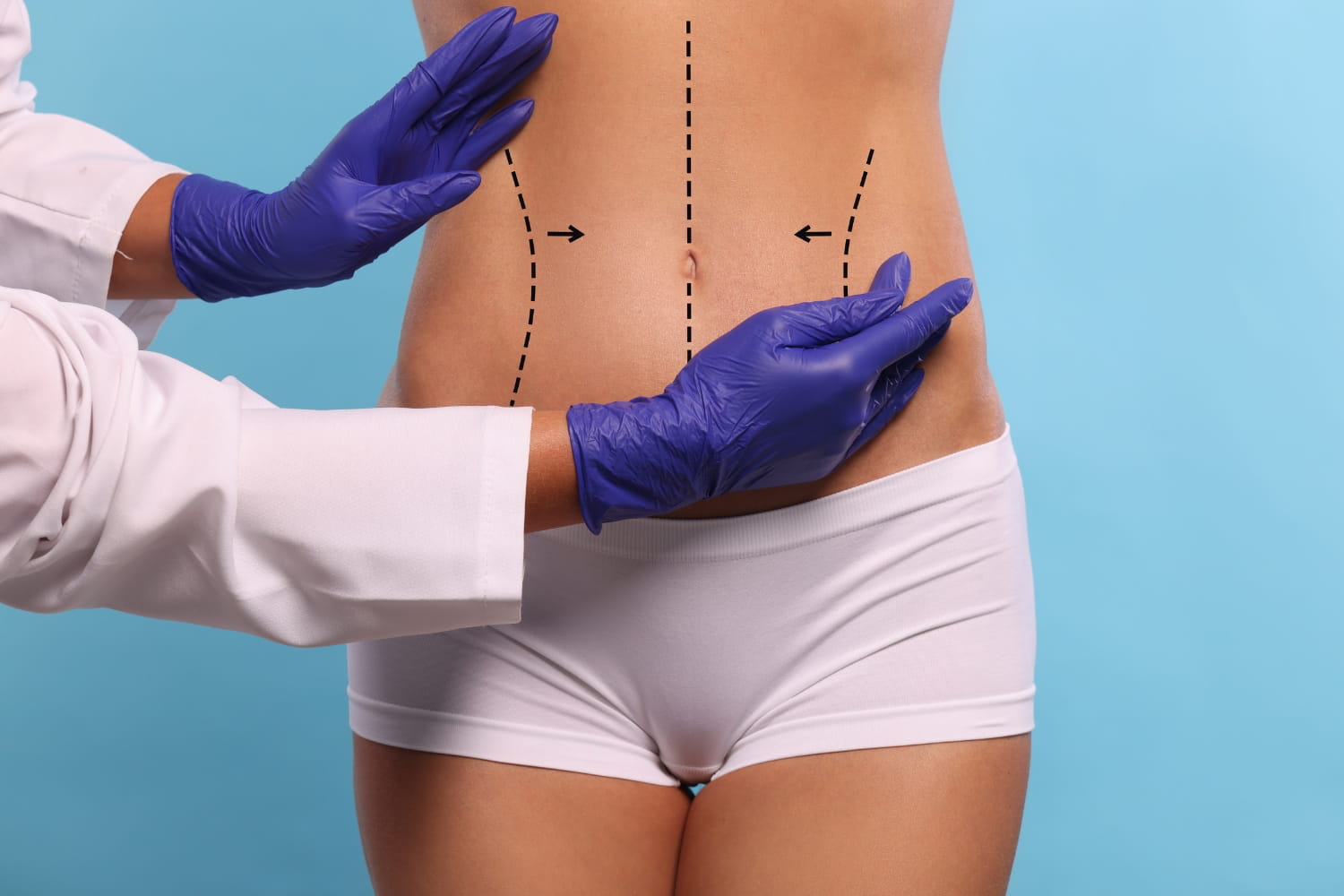 Сужение талии без удаления ребер