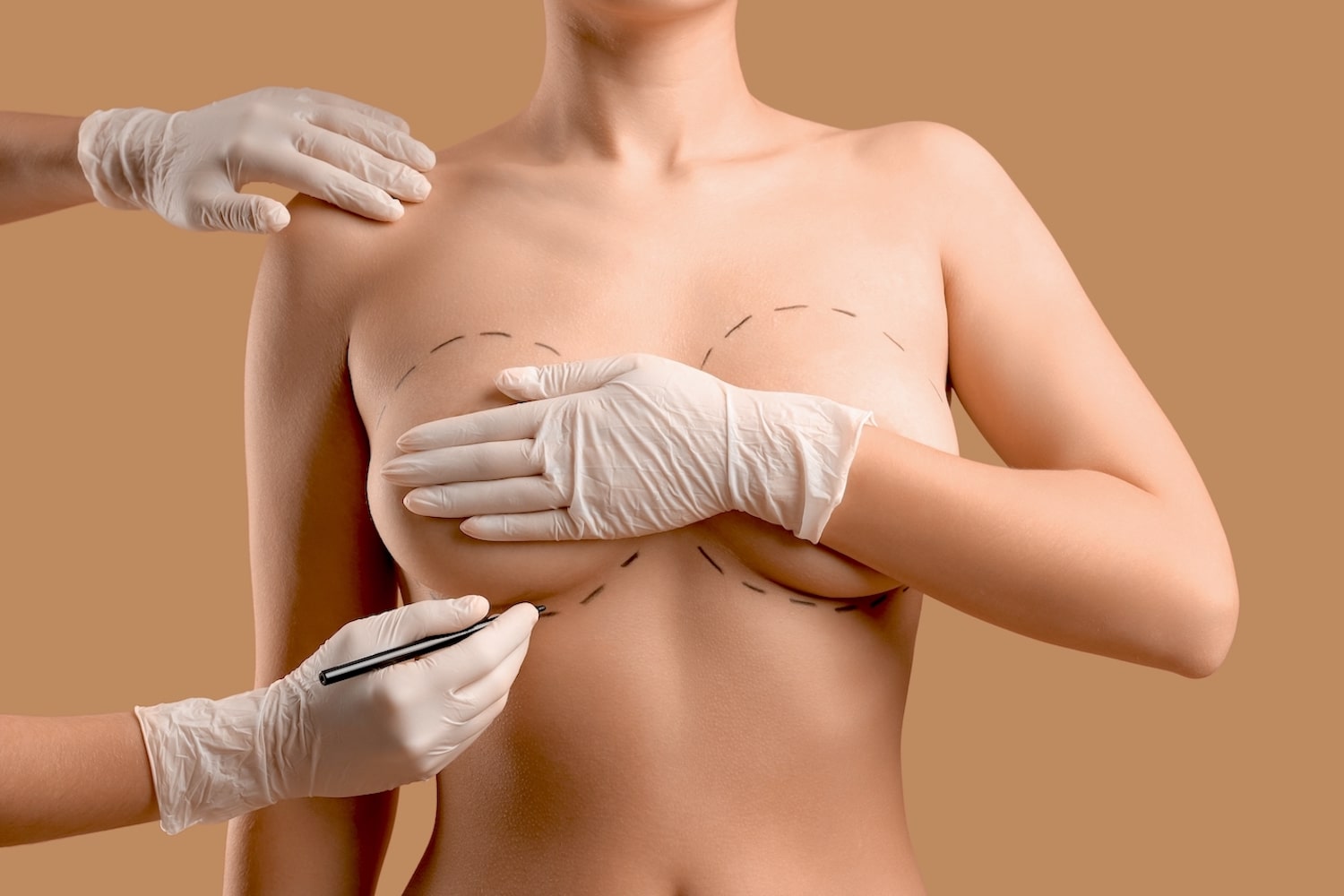 Подтяжка груди (мастопексия) в ОН КЛИНИК