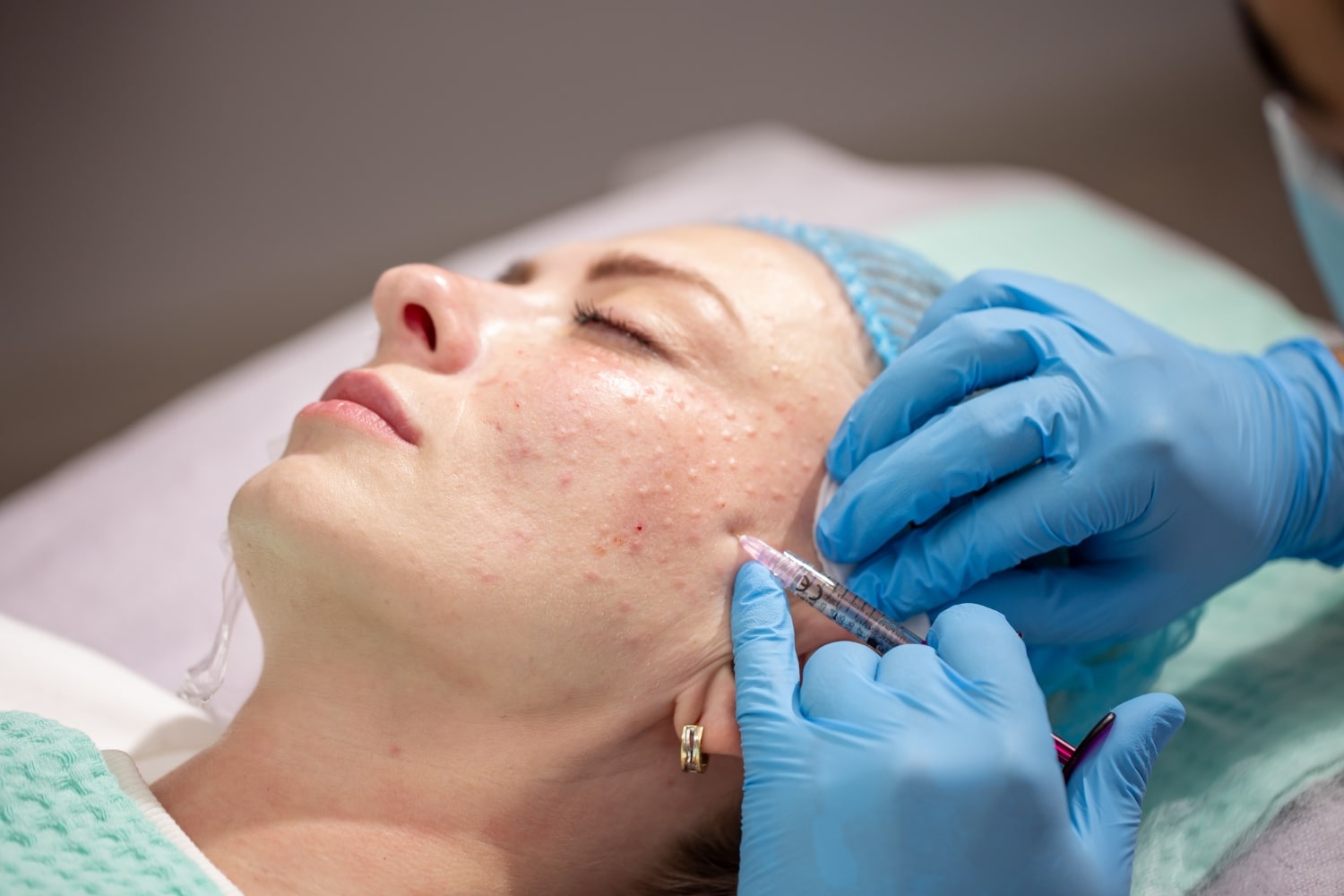 Биоревитализация Мезовартон