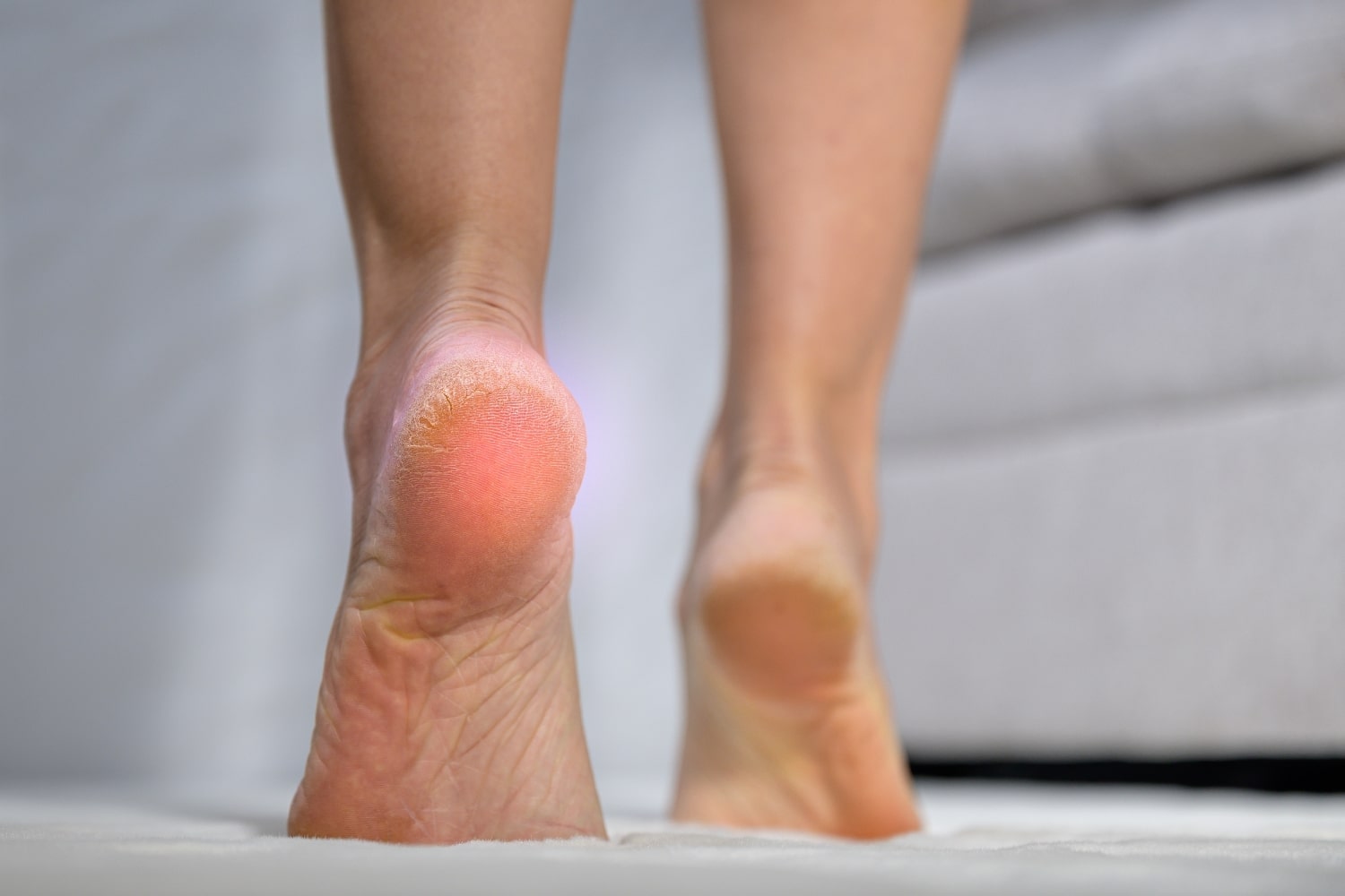 Огрубение кожи