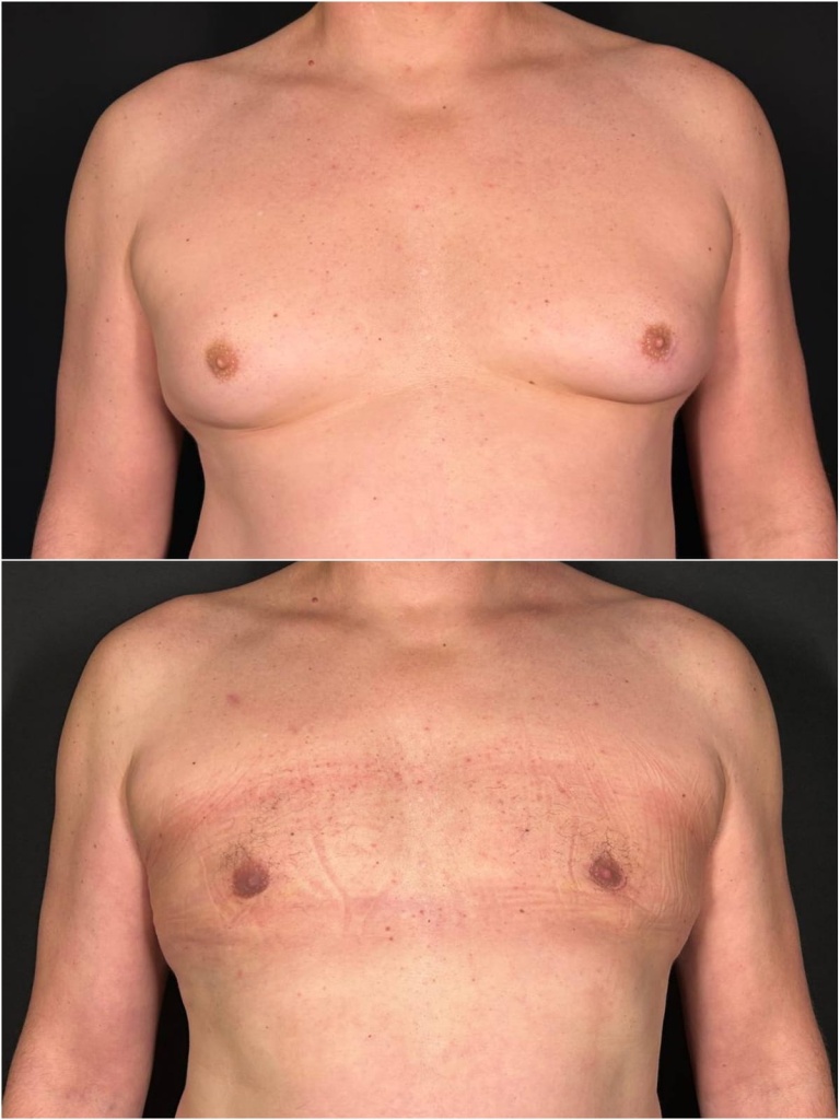 Результат операции по коррекции гинекомастии – фото до и после. Пластический хирург ОН КЛИНИК Тарасов Максим Дмитриевич