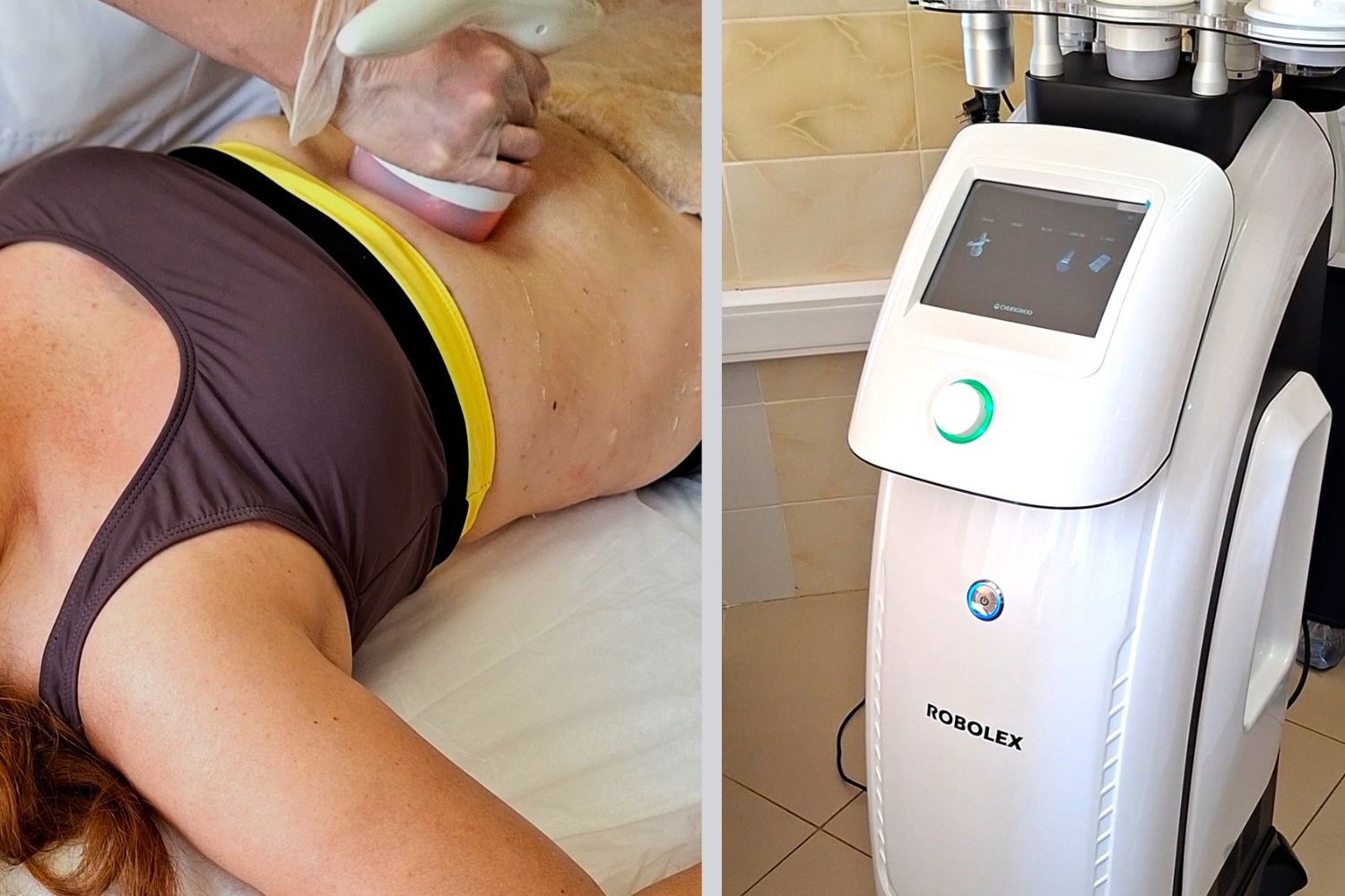 Robolex – безоперационная коррекция фигуры и омоложение Robolex – безоперационная коррекция фигуры и омоложение