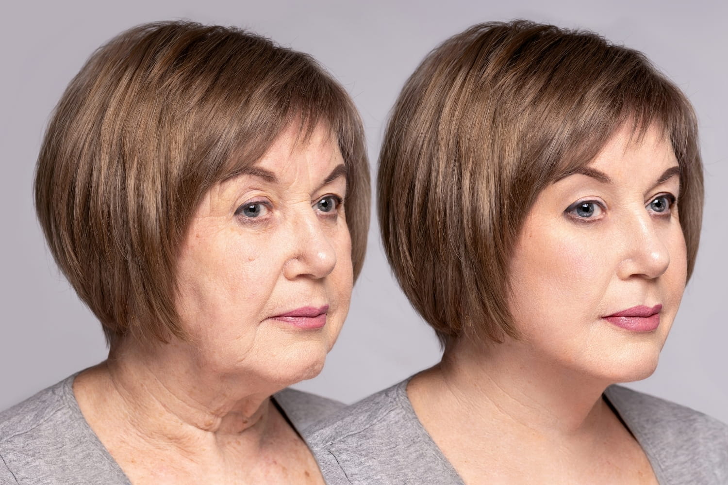 Результат композитного SMAS-лифтинга