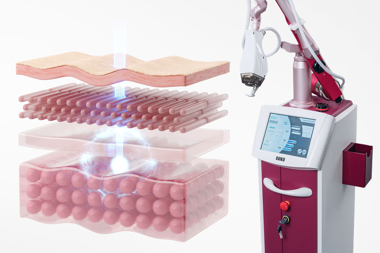 Омоложение и шлифовка фракционным лазером CO2 FONS SVR