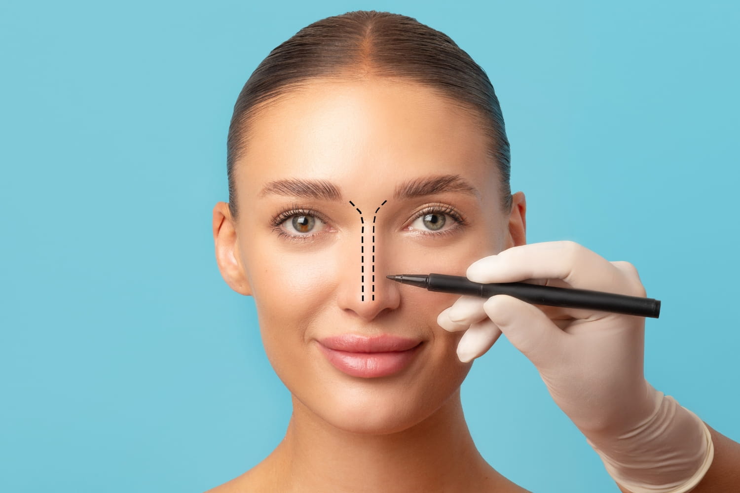 Идеальный нос без скальпеля: правда и мифы о безоперационной ринопластике