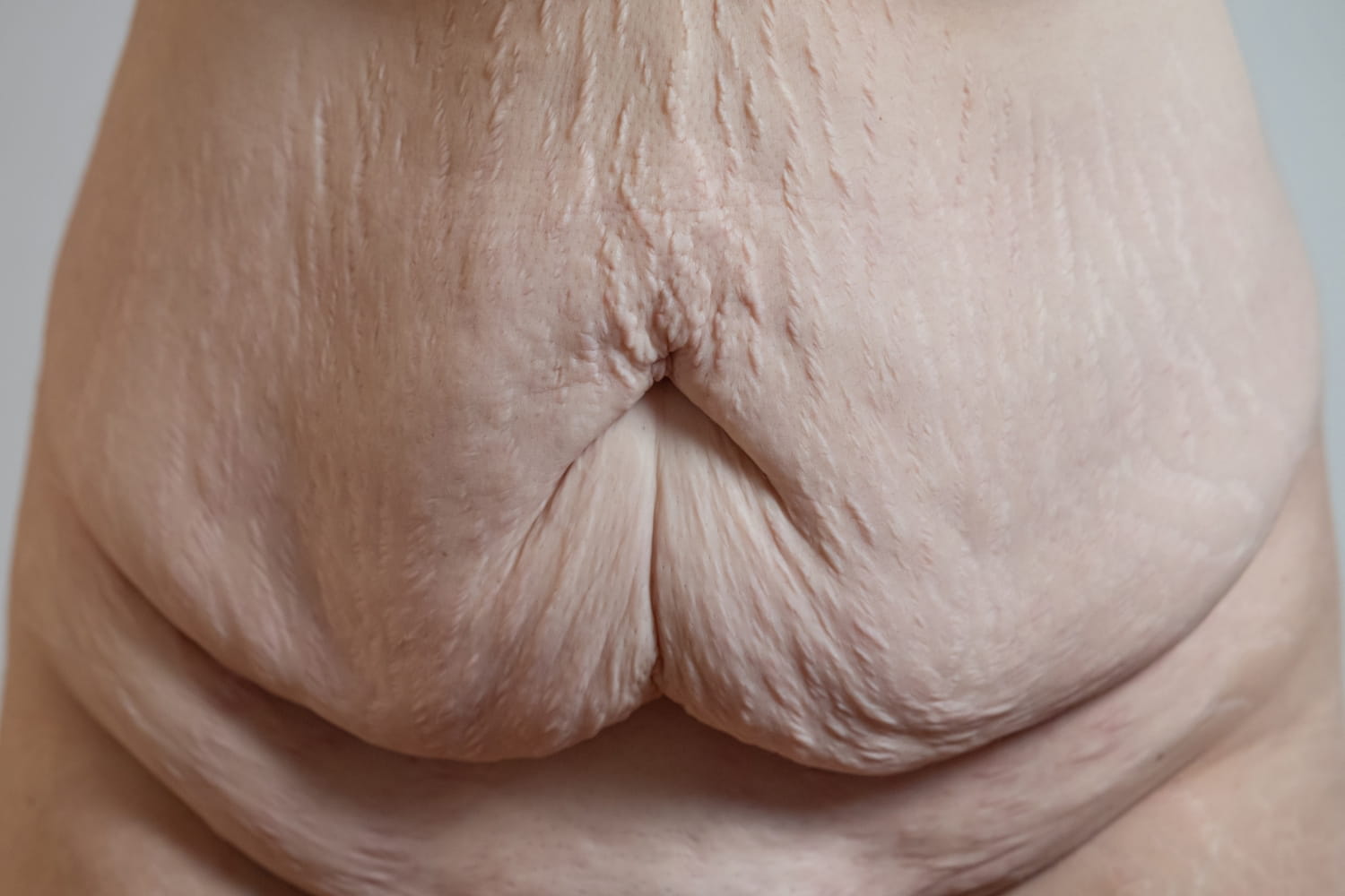 Абдоминопластика