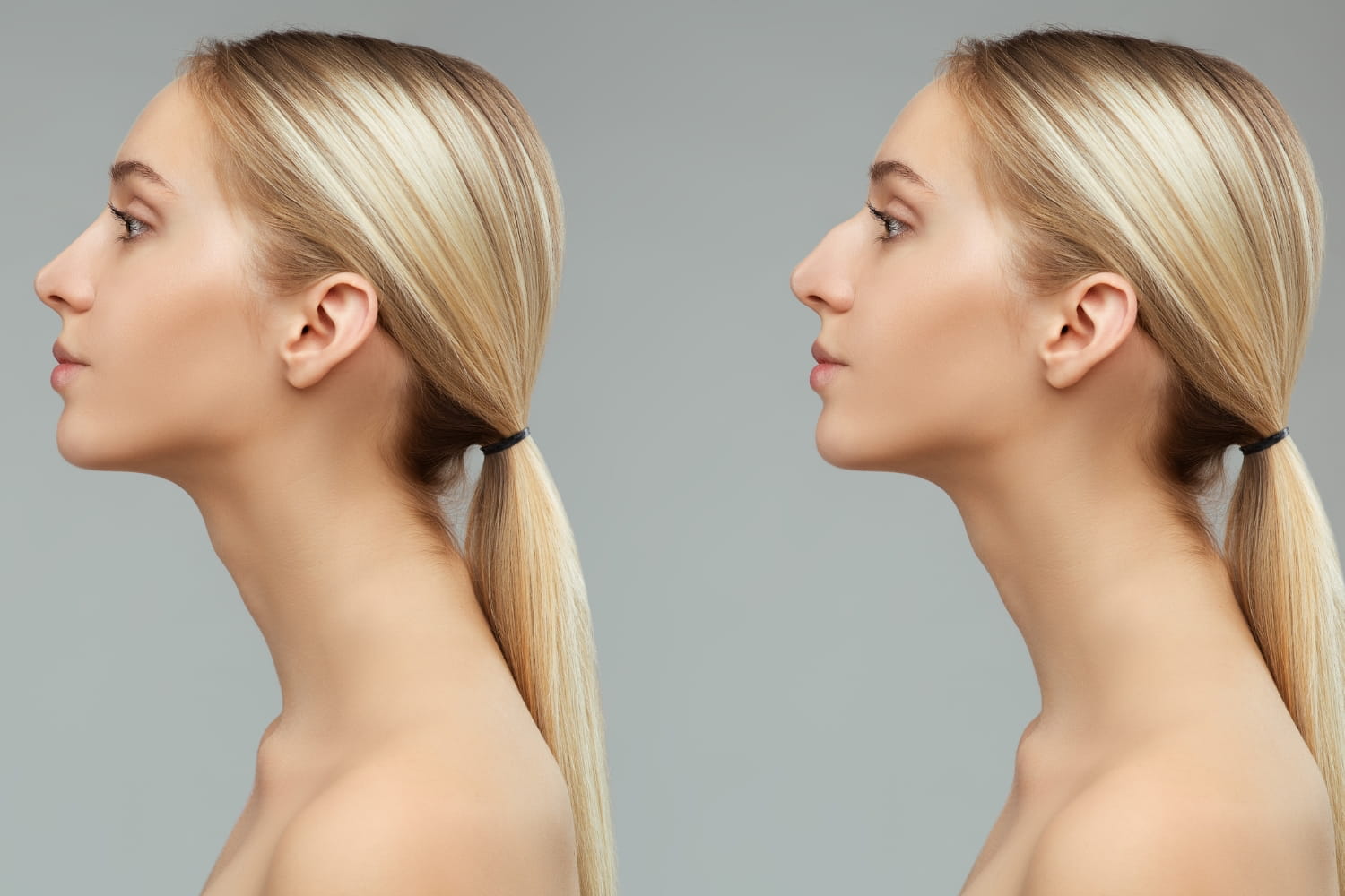 правда и мифы о безоперационной ринопластике