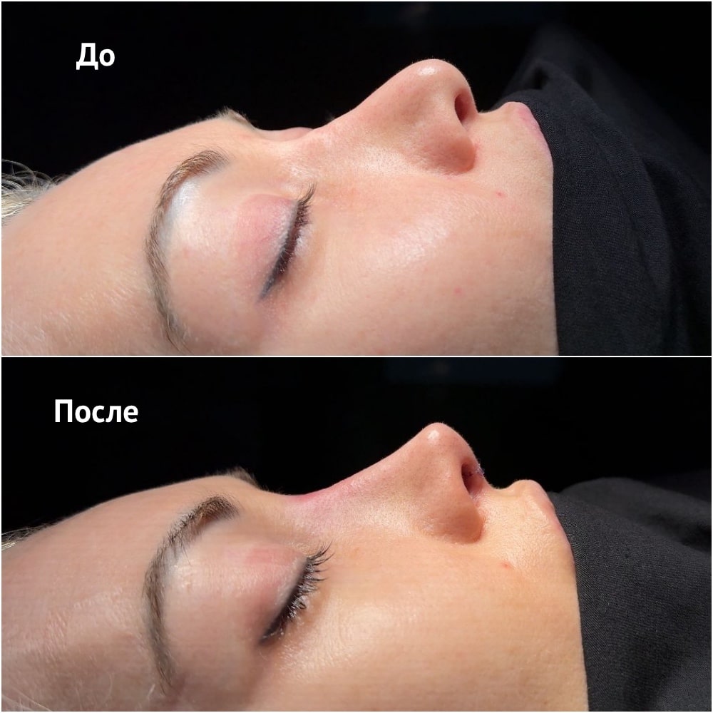 Фото до и после операции риносептопластики