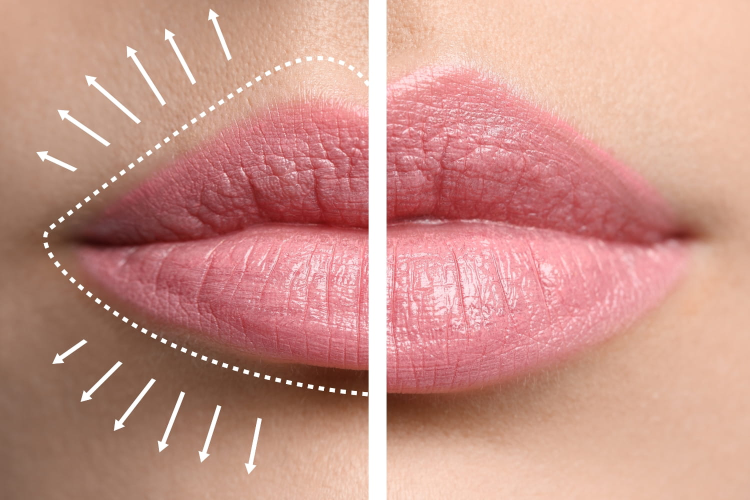 Этапы восстановления после хейлопластики Этапы восстановления после хейлопластики