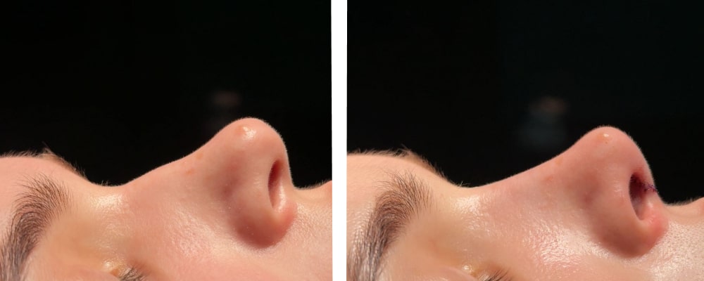 Фото до и после операции риносептопластики Фото до и после операции риносептопластики