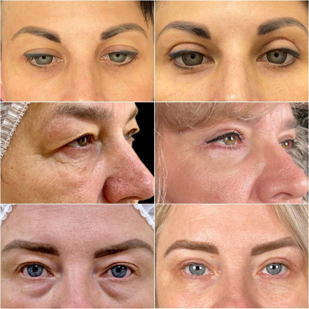 Примеры работ наших пластических хирургов по омоложению век – фото до и после операции