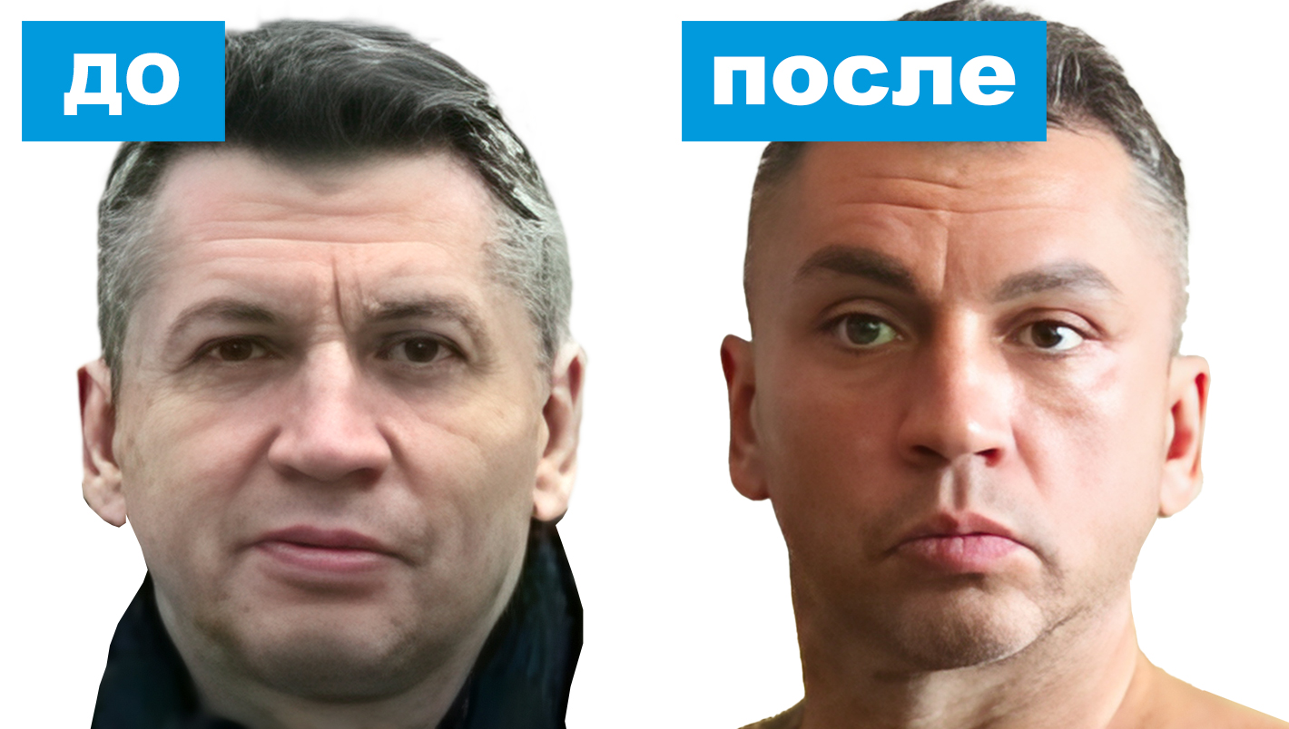 Блефаропластика для мужчин Блефаропластика для мужчин