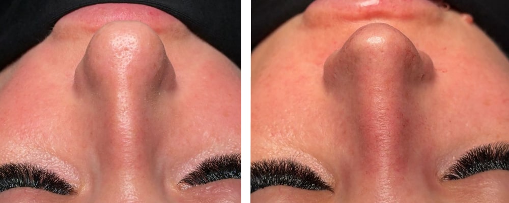 Фото до и после операции риносептопластики Фото до и после операции риносептопластики