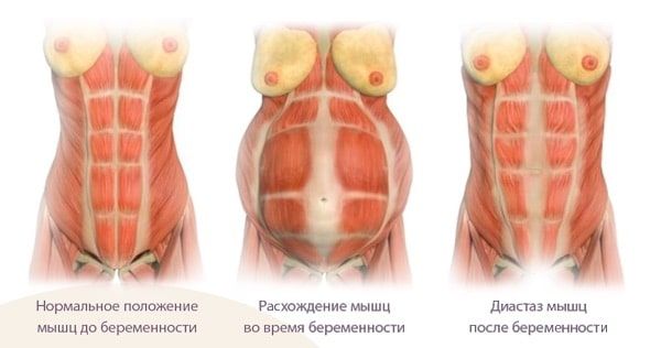 Диастаз мышц живота у женщин после родов. - Хирург К. В. Пучков
