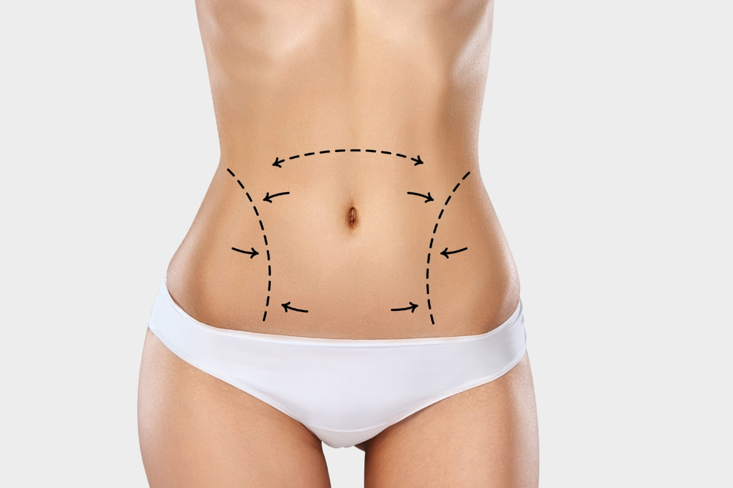 Какого эффекта можно ожидать после липоскульптурирования живота