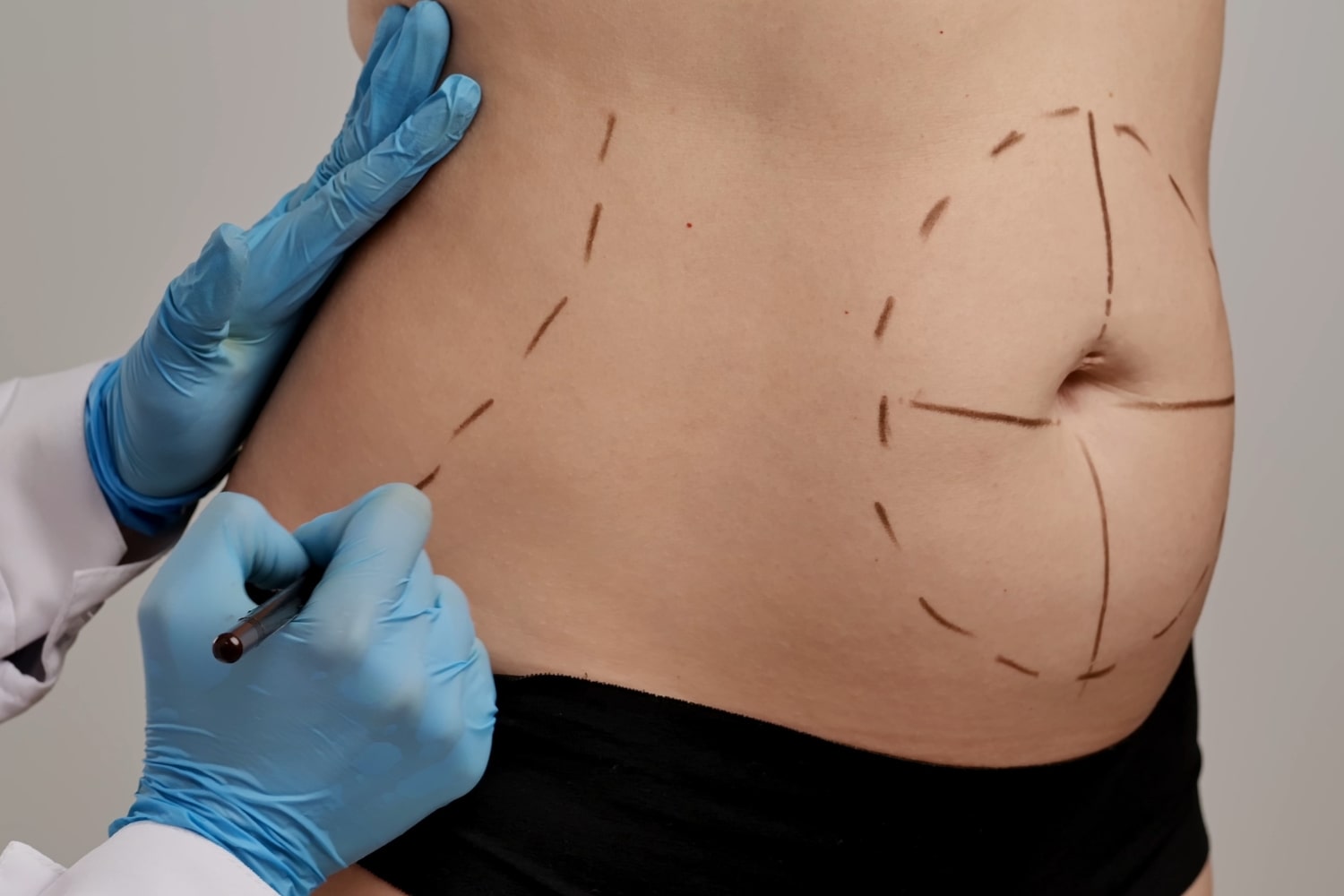 Противопоказания к абдоминопластике