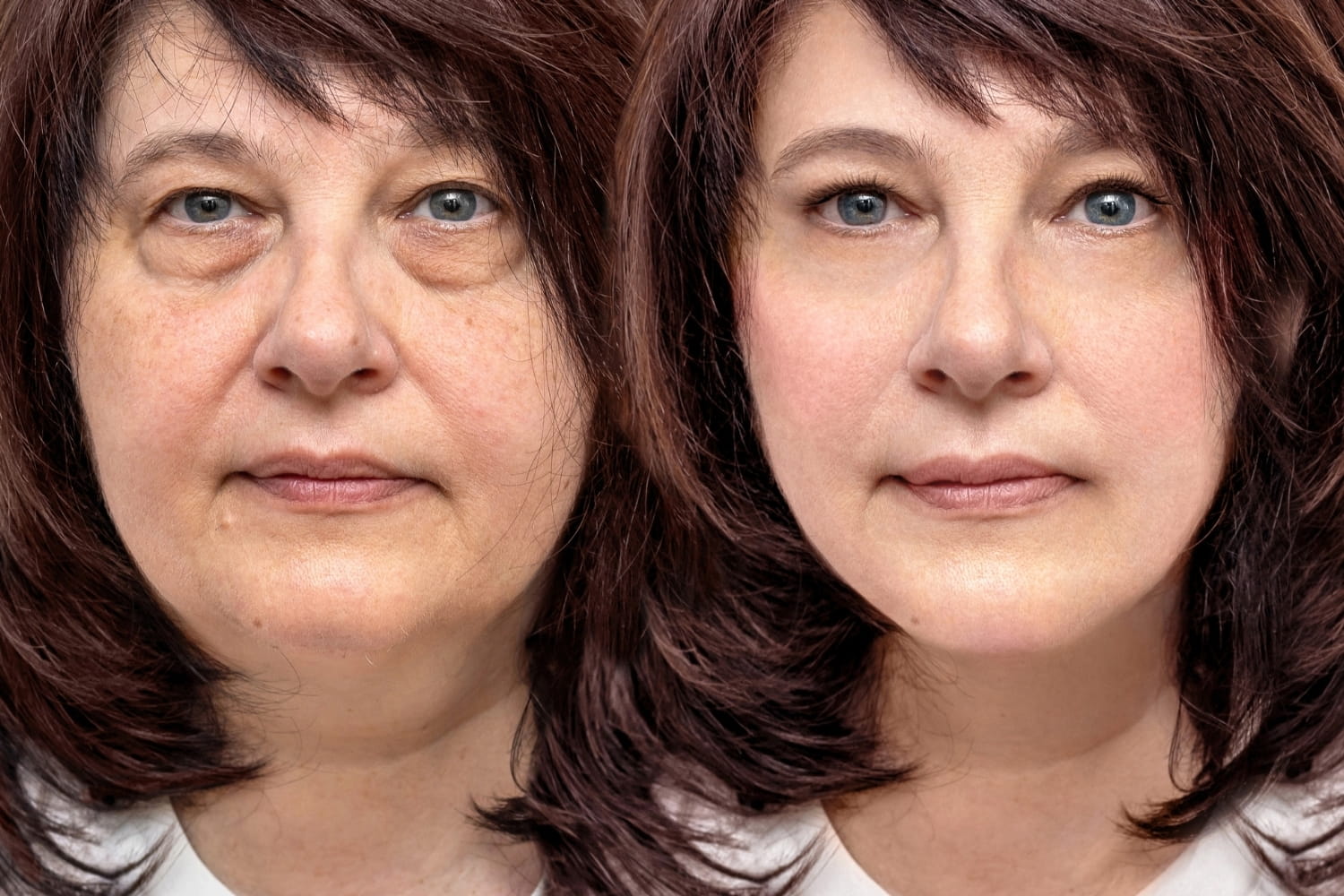 Композитный SMAS-лифтинг лица